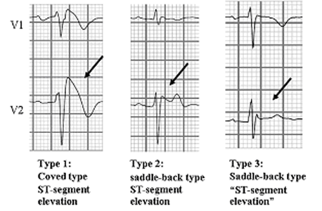 Type 2 ECG with saddle-back type ST-segment elevation in V 2 